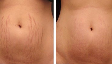 Dr. Amita Bharti's Post Delivery Stretch Mark & Lax Abdomen treatments at Reshapeyou Clinic in Patna