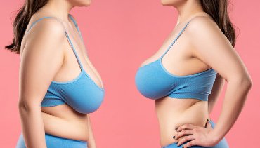 Dr. Amita Bharti of Reshapeyou Clinic in Patna can help you with Breast contouring & Breast Upliftment